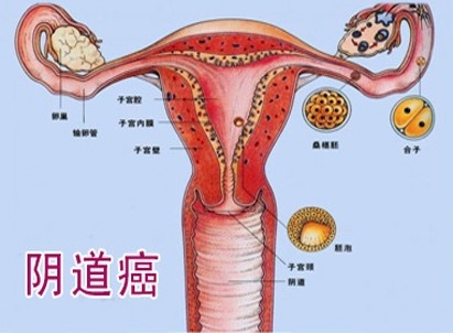 陰道腫瘤
 （陰道癌）
