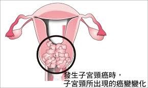 子宮頸癌